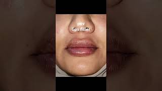 lips fillerفيلر شفاه explore اكسبلور filler lips lipfiller pov skincare تجميل shorts trend [upl. by Adnaral297]