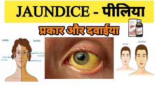 Jaundice treatment  Types of Jaundice  Symptoms of Jaundice  What is main cause of jaundice [upl. by Christos]