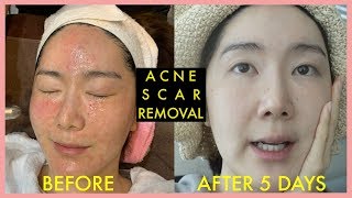 When your acne scar is just not going away Acne Scar Korean Treatment that works [upl. by Rachaba]