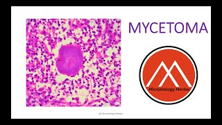 MYCETOMA Fungal infection 🔬🧫 Subcutaneous mycoses [upl. by Segalman875]