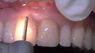 Protemp 4  High Performance Provisional Restoration  Dental Training [upl. by Torosian]