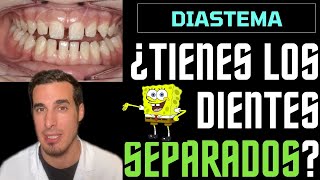 ¿Tienes los DIENTES SEPARADOS  DIASTEMA DENTAL o ESPACIO entre los DIENTES [upl. by Woodhead]