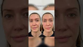 TEAR TROUGH FILLER RESULTS  DR MEDISPA [upl. by Applegate]