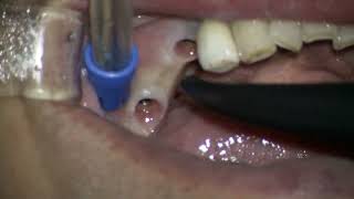 Straumann 2 BLT final set in posterior mandible [upl. by Kcinimod]