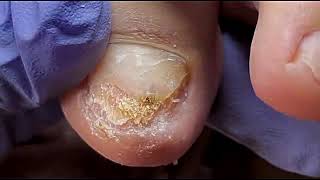 DIY Ingrown Toenail Removal  How to Safely Cut Ingrown Toenails at Home [upl. by Lytsyrk]