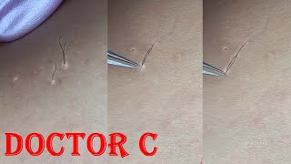 09 clear ingrown hair [upl. by Notgnilra773]