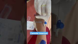 Cannula insertion of female patient nurses cannula shortsmbbs youtubeshorts subscribe neet [upl. by Aivart]