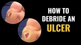 Educational Video How To Debride An Ulcer [upl. by Eniretak]