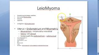 Pathology 721 a Leiomyoma FIBROID uterus fibromyoma Smooth muscle benign Gross specimen Practical [upl. by Nosecyrb]