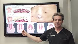 What is diastasis of rectus muscles by Dr Iraniha [upl. by Spencer451]