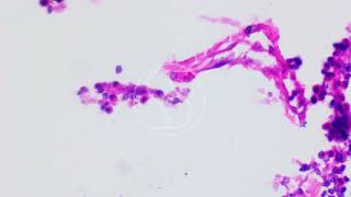 Basidiobolus from Gastrointestinal with Haematoxylin and Eosin HampE Staining [upl. by Elisee146]