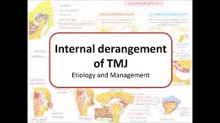 Internal derangement of TMJ Etiology amp Management Arthrocentesis Arthroscopy Condylectomy [upl. by Bodwell]