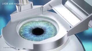 LASIK Treatment Animation [upl. by Brucie327]