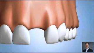 Ridge Atrophy  Bone loss after Tooth Loss [upl. by Roban923]