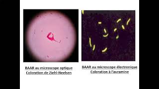 06Tuberculose extrapulmonaire TEP Pr Yahaoui Beni Messousse  Pneumo [upl. by Lennor]