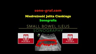 Sonografia  Niedrożność Jelita Cienkiego [upl. by Melinda]