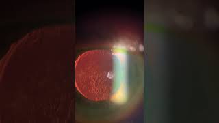 Moderate Posterior Capsular Opacification with decreased vision Recommend YAG Capsulotomy [upl. by Neale]