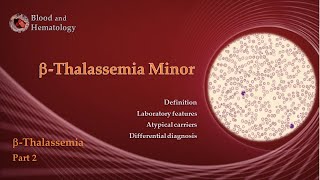 BetaThalassemia part 2  BetaThalassemia Minor [upl. by Yentuoc950]