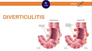 Diverticulitis ParaelENARM [upl. by Tolmann]