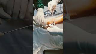 Cruciate ligament repair ligament surgery  mozart peroneus longus [upl. by Milde]