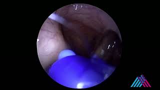 Eustachian tube balloon dilation for eustachian tube dysfunction [upl. by Gabrielson]