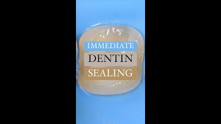 Immediate Dentin Sealing is necessary for biomimetic dentistry [upl. by Ehtnax774]