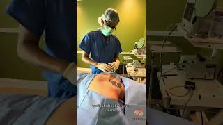 Buffalo Hump Removal by Dr Viradia tampa plasticsurgeon awake [upl. by Ttelrahc754]