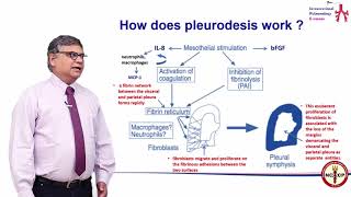 Pleurodosis  Dr Dharmesh Patel  IPeC [upl. by Livvie]