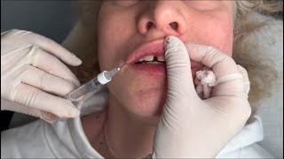 Professional Lip Filler Injection Guide Safe amp Effective Technique Explained [upl. by Letrice]