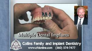 Partial dentures vs dental implants by Collins Family and Implant Dentistry Vancouver WA [upl. by Wilkins]