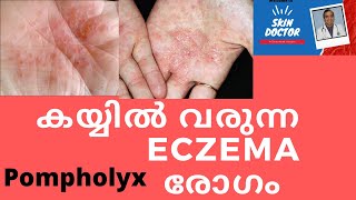 കയ്യിൽ വരുന്ന eczema രോഗം pompholyx hand eczema dr sujith kumar Dermatologist [upl. by Steady]