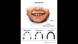 Anodontia  Symptoms and Causes  Diagnosis  Treatment  Prevention [upl. by Fredi]