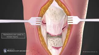 Patella Tendon Repair [upl. by Reid]