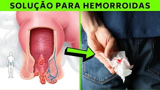 Como Curar Hemorroida Em 2 Dias  Tratamento Caseiro Para Hemorroida  Sintomas HEMORROIDA INFLAMADA [upl. by Silra]