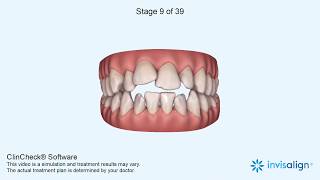 Invisalign Clincheck [upl. by Reena366]