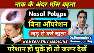 नाक के अंदर माँस बढ़ना। Nasal Polyps Treatment Without Surgery। Nasal Polyps Homeopathic Medicine। [upl. by Major]