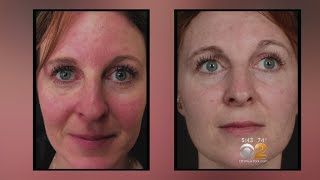 Health Watch New Laser Treatment For Rosacea [upl. by Aiynat]