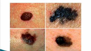 Cancerous moles and warts [upl. by Loella512]