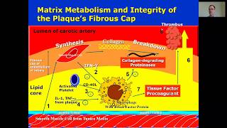 Lesson 2 5 Fibrous Cap and Thrombus Formation [upl. by Gebler]