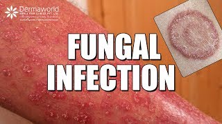 Suffering from Fungal Infection Ringworms WATCH THIS [upl. by Akanke]