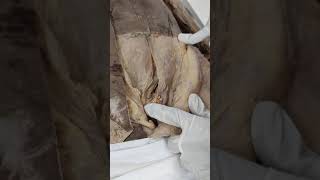 Dissection of Inguinal canal [upl. by Leima]