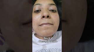 Day 6 of Benzoylperoxide benzoylperoxide skincare acne acnescars combinationskin [upl. by Ydner]