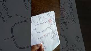 pathogenesis of glomerulonephritis NGMedicals [upl. by Stoddard]