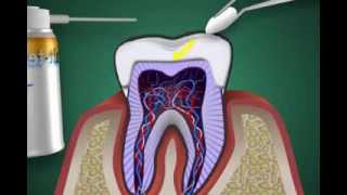 was ist eine Zahnnerventzündung  Pulpitis [upl. by Edasalof]