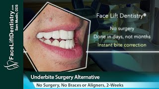 Correct Underbites  No Surgery No Braces [upl. by Tamer605]