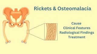 Rickets amp Osteomalacia Causes Clinical features Radiological features Treatment [upl. by Adiari]