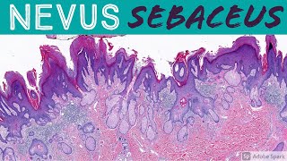 Nevus Sebaceus quotNevusquot  birthmark not melanocytes in this case Pathology Dermatology [upl. by Isoj]