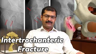 What is the Treatment for Intertrochanteric Fracture Dr Soundar [upl. by Reddy69]