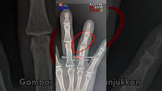 Xray nampak ada retak [upl. by Naloc250]