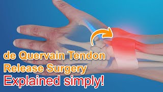 De Quervain Tendon Release Surgery  Explained [upl. by Finkelstein37]